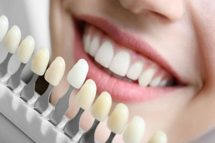 5 Indicators You Might Need Enamel Shaping For Cosmetic Enhancement