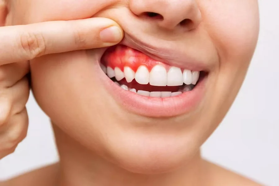 Gum Health