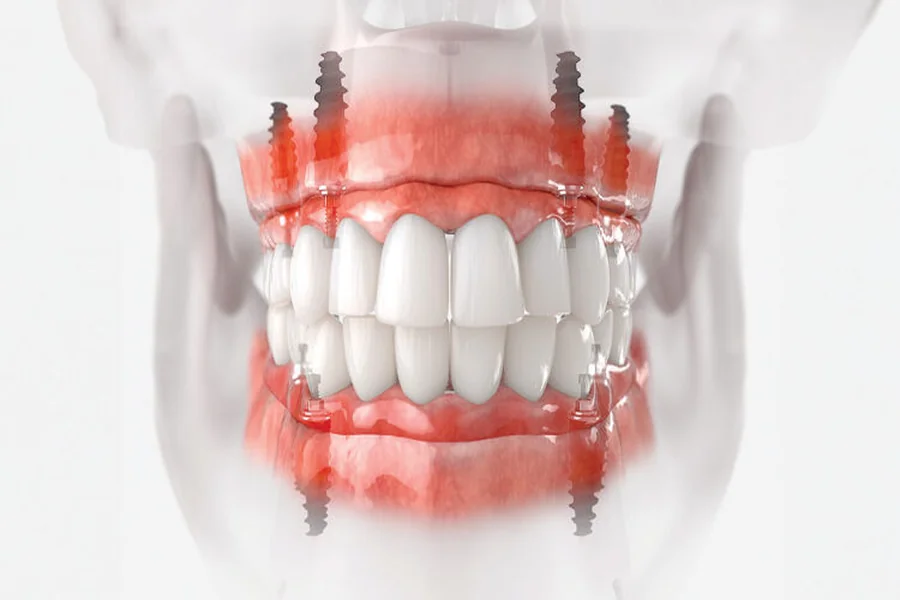 Implant Dentistry